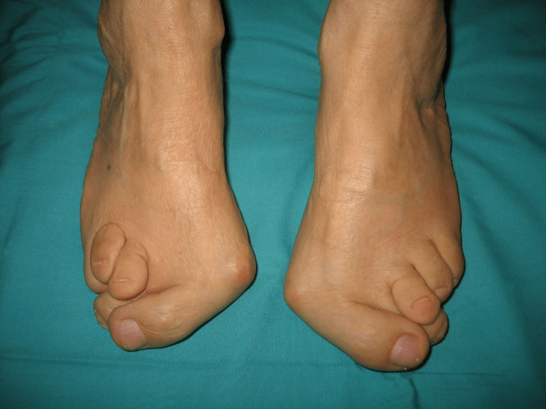 Silne deformacja