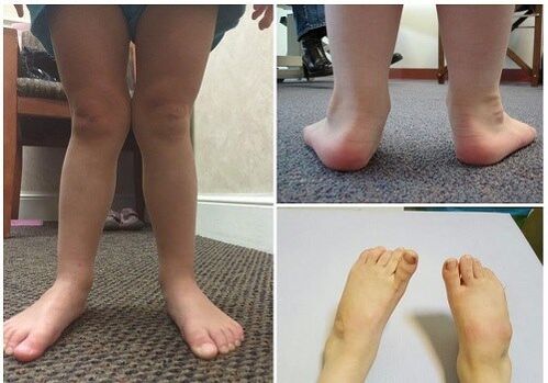 Deformacja Valgus u dzieci