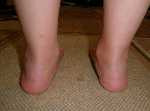 stopa końsko-szpotawa wrodzona deformacja stopy